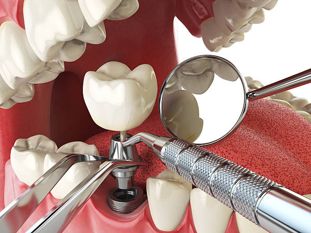 Best Broken or Cracked Tooth Emergency Dentist in Jonesboro, GA